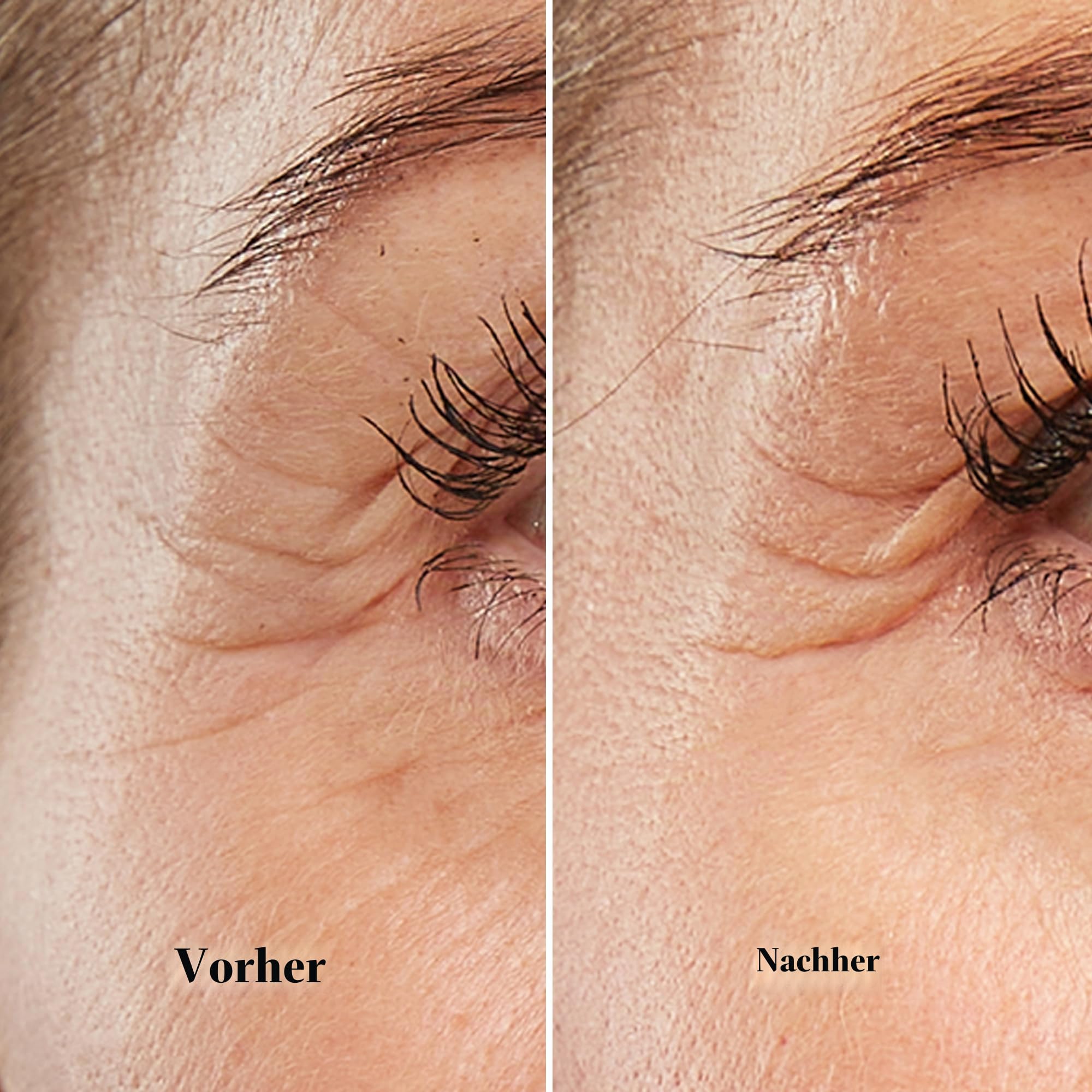 silk-n-facetite-mini-anti-aging-ger-t-radiofrequenz-led-f-r-augen-mund-und-braue image 6